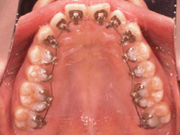 写真：上の歯につけた裏側の装置