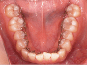 写真：下の歯につけた裏側の装置